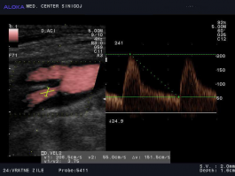 Ultrazvok vratnih žil - maščobni plak v notranji karotidni arteriji